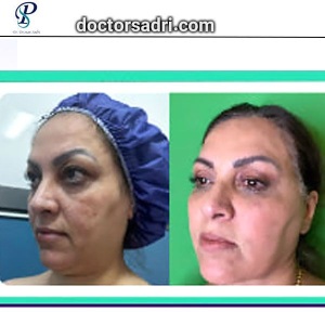 Blepharoplasty