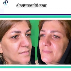 Blepharoplasty2