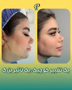 Ghabghab-liposuction-12