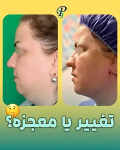 Ghabghab-liposuction-13