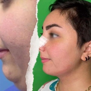Ghabghab-liposuction-7