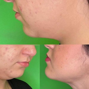 Ghabghab-liposuction-8