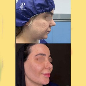 Ghabghab-liposuction.10