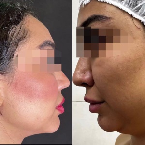Ghabghab-liposuction.3