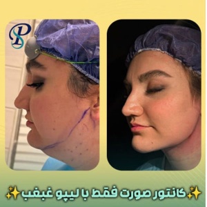 Ghabghab-liposuction.9