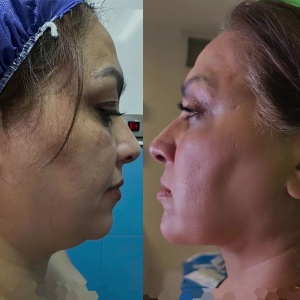 Ghabghab-liposuction