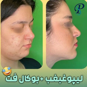 Ghabghab-liposuction.jpg11