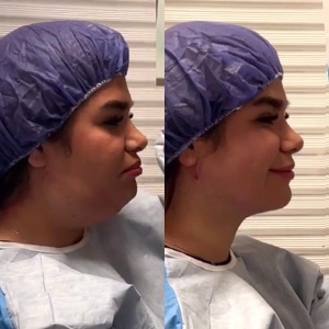 Ghabghab-liposuction2