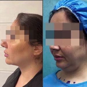 Ghabghab-liposuction4