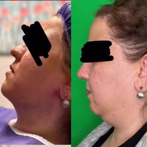 Ghabghab-liposuction5jpg
