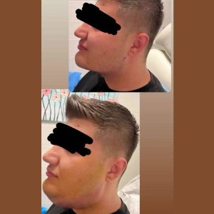 Ghabghab-liposuction6