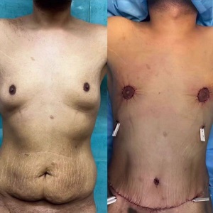 Liposuction3