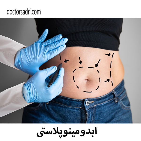 ابدومینوپلاستی - دکتر پیمان صدری