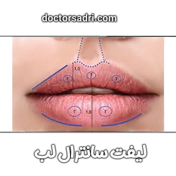لیفت سانترال لب
