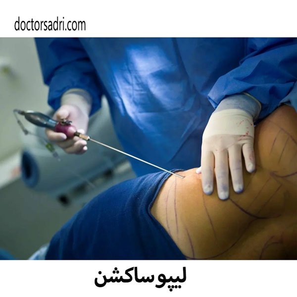 لیپوساکشن - دکتر صدری