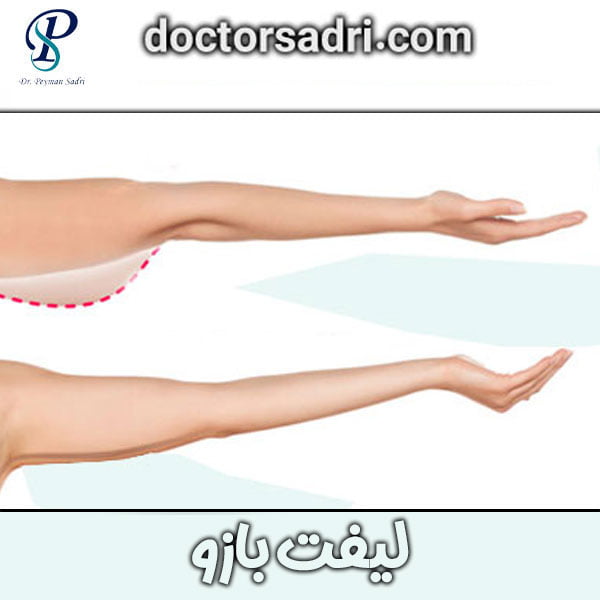 براکیوپلاستی یا لیفت بازو دکتر صدری در تهران