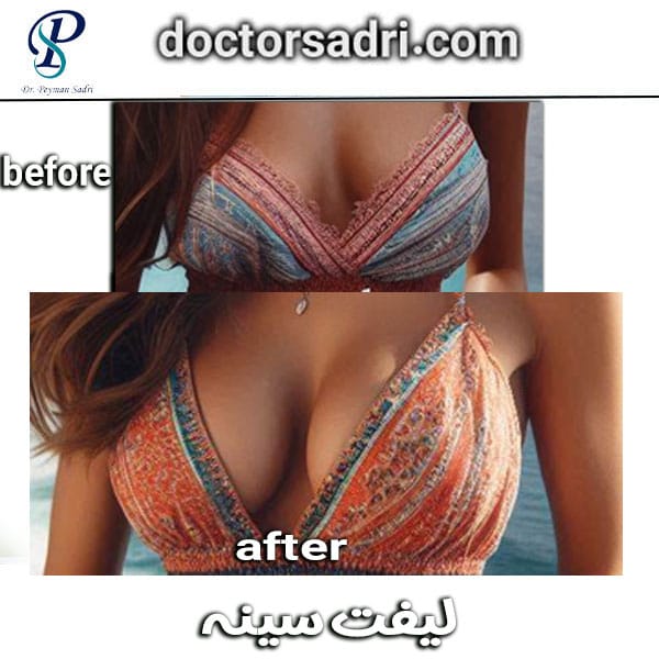 لیفت سینه در تهران _ دکتر پیمان صدری