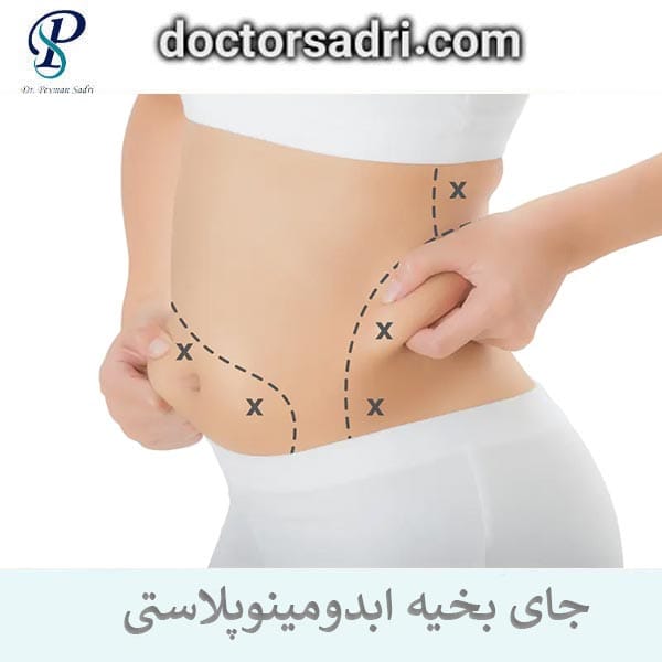 رفع اسکار بخیه ابدومینوپلاستی _ دکتر پیمان صدری
