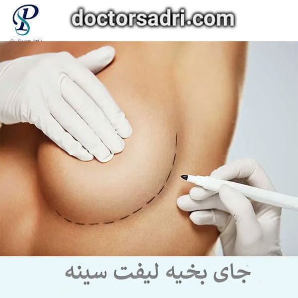 جای بخیه لیفت سینه _ دکتر پیمان صدری