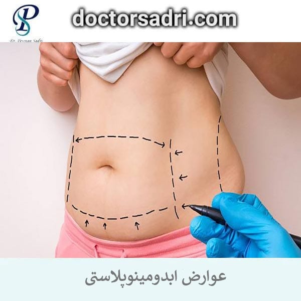 عوارض ابدومینوپلاستی _ دکتر پیمان صدری