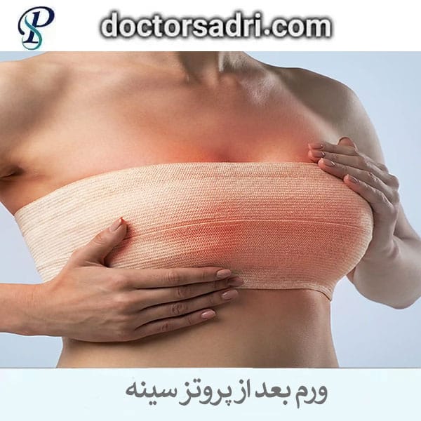 ورم بعد از عمل پروتز سینه _ دکتر پیمان صدری